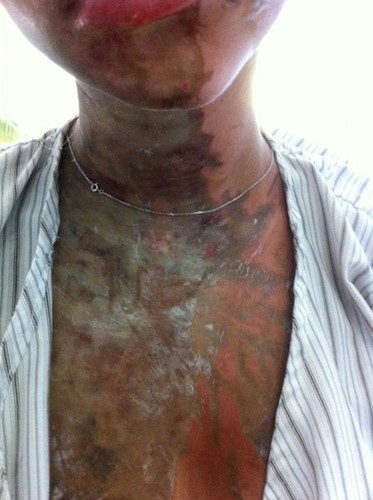 How Many Acid Attacks Occur in the World?